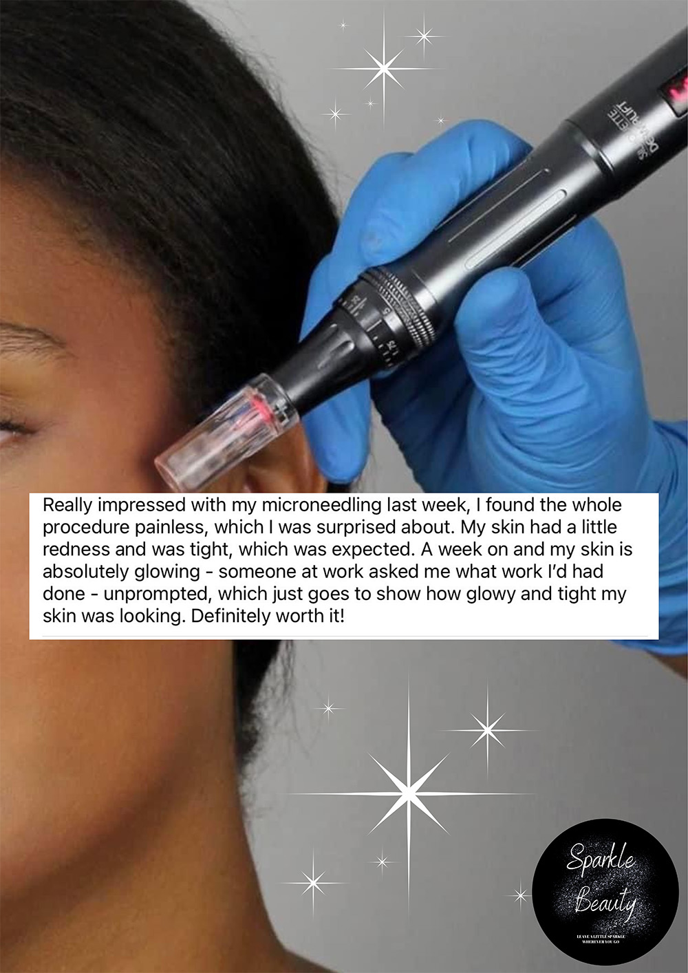A review after a microneedling treatment