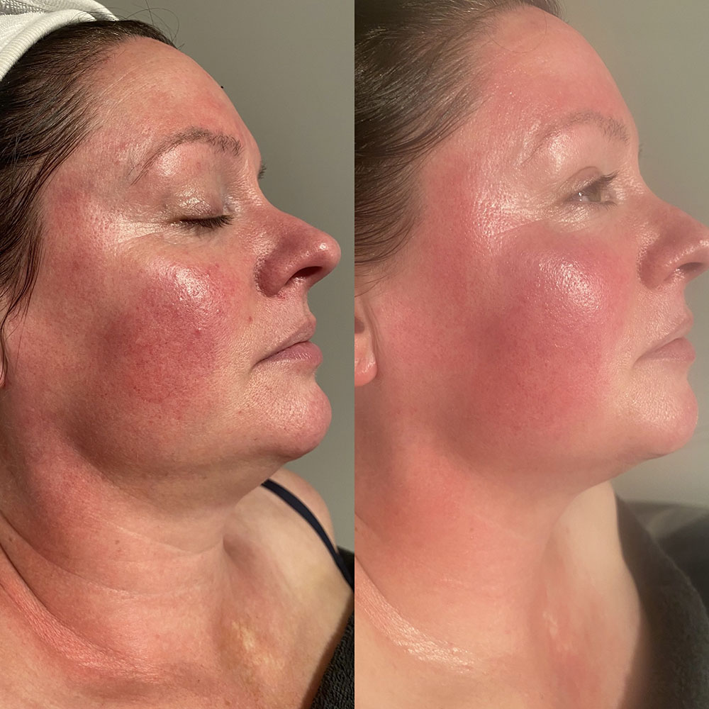 Before and after photo following radio frequency treatment - photo 1