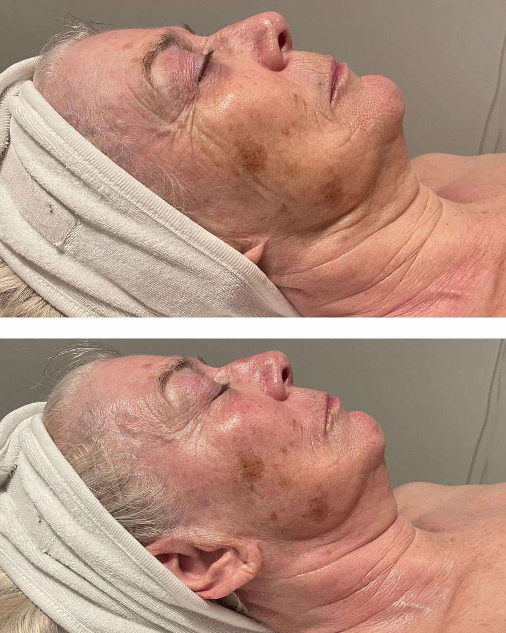 Before and after photo following radio frequency treatment - photo 2