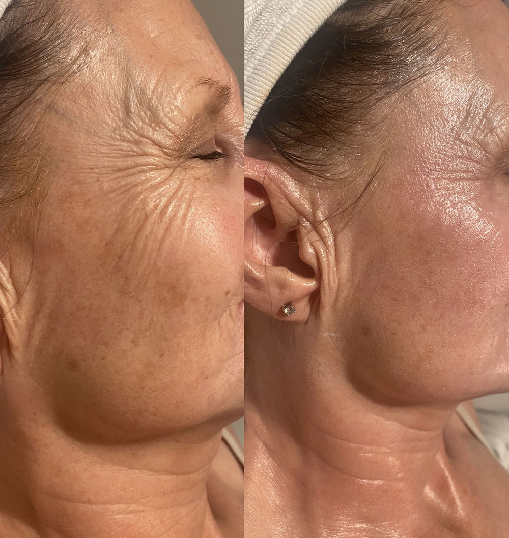 Before and after photo following radio frequency treatment - photo 3